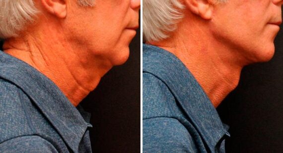 Minilift / Facelift Before and After Photos in Cincinnati, OH, Patient 7896