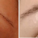 Fat Transfer Before and After Photos in Cincinnati, OH, Patient 8063