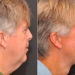 Male Plastic Surgery Before and After Photos in Cincinnati, OH, Patient 8092
