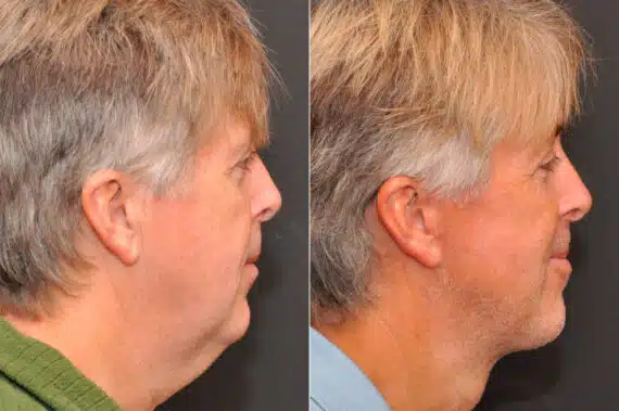 Male Plastic Surgery Before and After Photos in Cincinnati, OH, Patient 8092