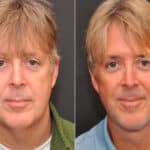 Male Plastic Surgery Before and After Photos in Cincinnati, OH, Patient 8092