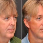 Male Plastic Surgery Before and After Photos in Cincinnati, OH, Patient 8092