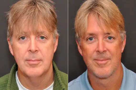 Male Plastic Surgery Before and After Photos in Cincinnati, OH, Patient 8092