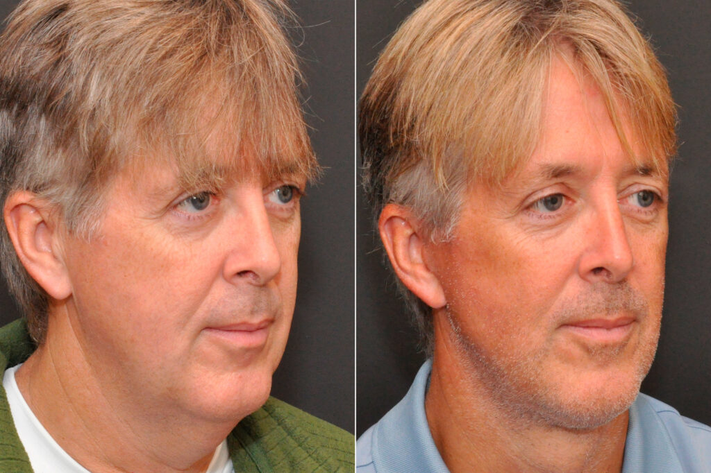 Minilift / Facelift Photos Cincinnati, OH Patient 8102