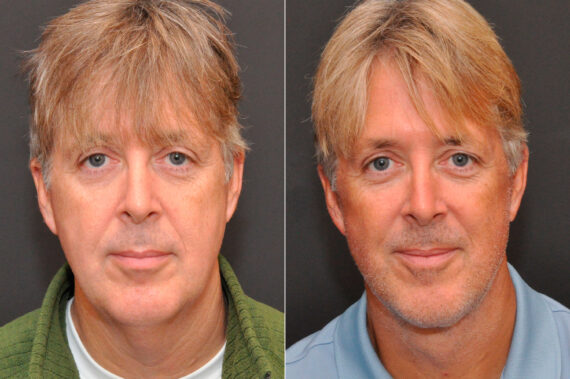 Minilift / Facelift Before and After Photos in Cincinnati, OH, Patient 8102