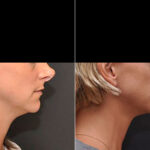 Revision Rhinoplasty Before and After Photos in Cincinnati, OH, Patient 8126