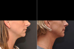 Revision Rhinoplasty Before and After Photos in Cincinnati, OH, Patient 8126