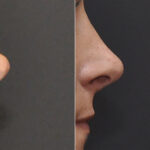 Revision Rhinoplasty Before and After Photos in Cincinnati, OH, Patient 8126