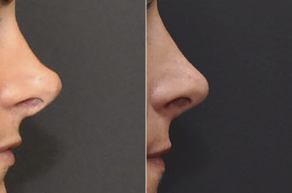 Revision Rhinoplasty Before and After Photos in Cincinnati, OH, Patient 8126