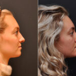 Rhinoplasty (Nose Reshaping) Before and After Photos in Cincinnati, OH, Patient 8138