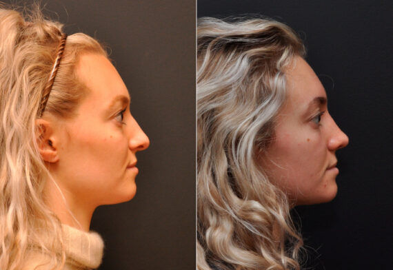 Rhinoplasty (Nose Reshaping) Before and After Photos in Cincinnati, OH, Patient 8138