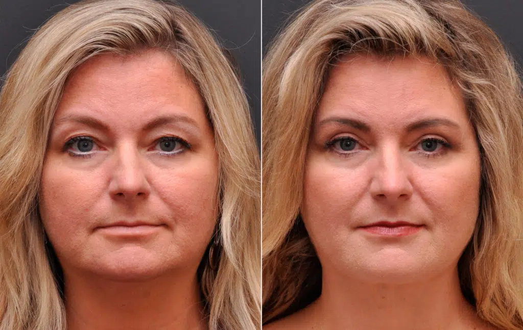 Blepharoplasty Photos Cincinnati, OH Patient 8352