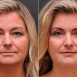 Blepharoplasty Before and After Photos in Cincinnati, OH, Patient 8352