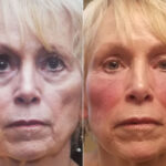 Cosmetic Injectables Before and After Photos in Cincinnati, OH, Patient 8335