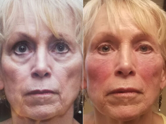 Cosmetic Injectables Before and After Photos in Cincinnati, OH, Patient 8335