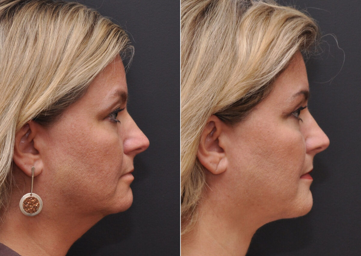 Facial Liposuction Before and After Photos in Cincinnati, OH, Patient 8345