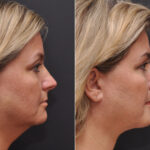 Facial Liposuction Before and After Photos in Cincinnati, OH, Patient 8345