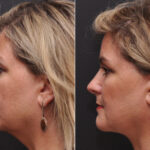 Facial Liposuction Before and After Photos in Cincinnati, OH, Patient 8345