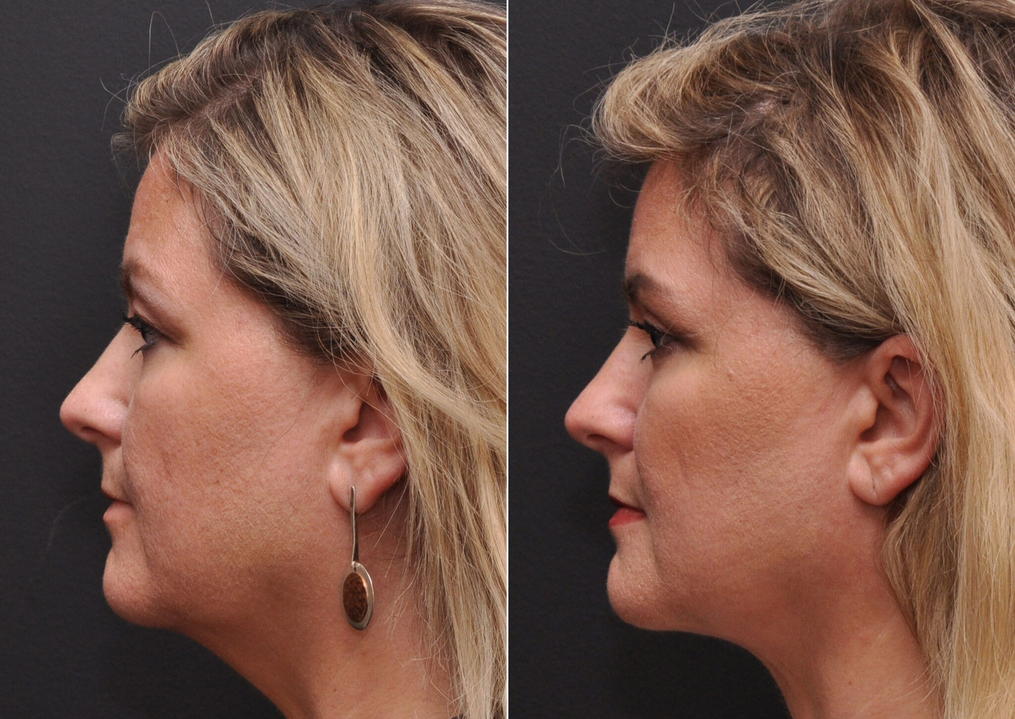 Facial Liposuction Photos Cincinnati Facial Plastic Surgery