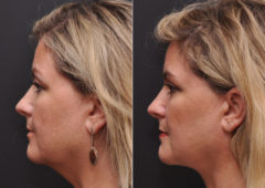 Facial Liposuction Before and After Photos in Cincinnati, OH, Patient 8345