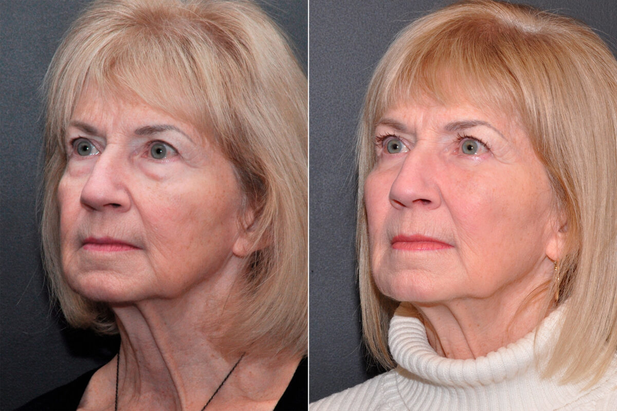 Blepharoplasty Before and After Photos in Cincinnati, OH, Patient 8473