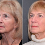 Blepharoplasty Before and After Photos in Cincinnati, OH, Patient 8473