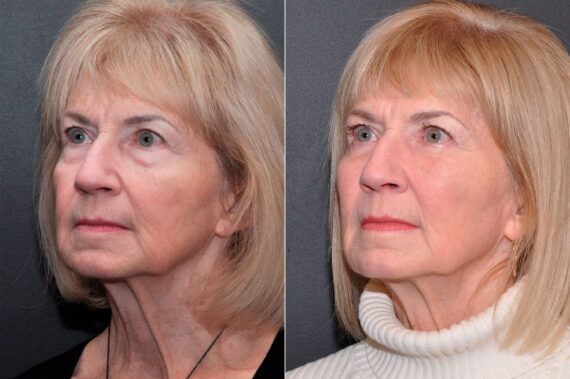 Blepharoplasty Before and After Photos in Cincinnati, OH, Patient 8473