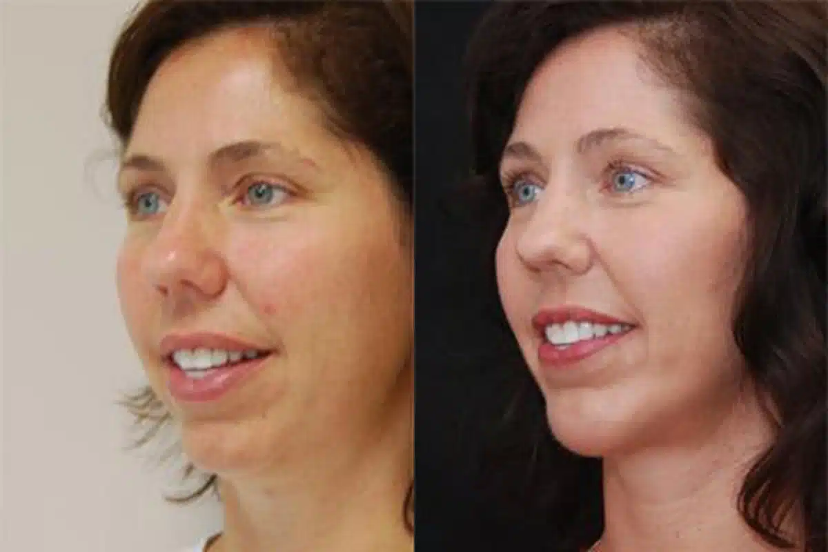 Cincinnati Chin Augmentation Plastic Surgery in Cincinnati, OH