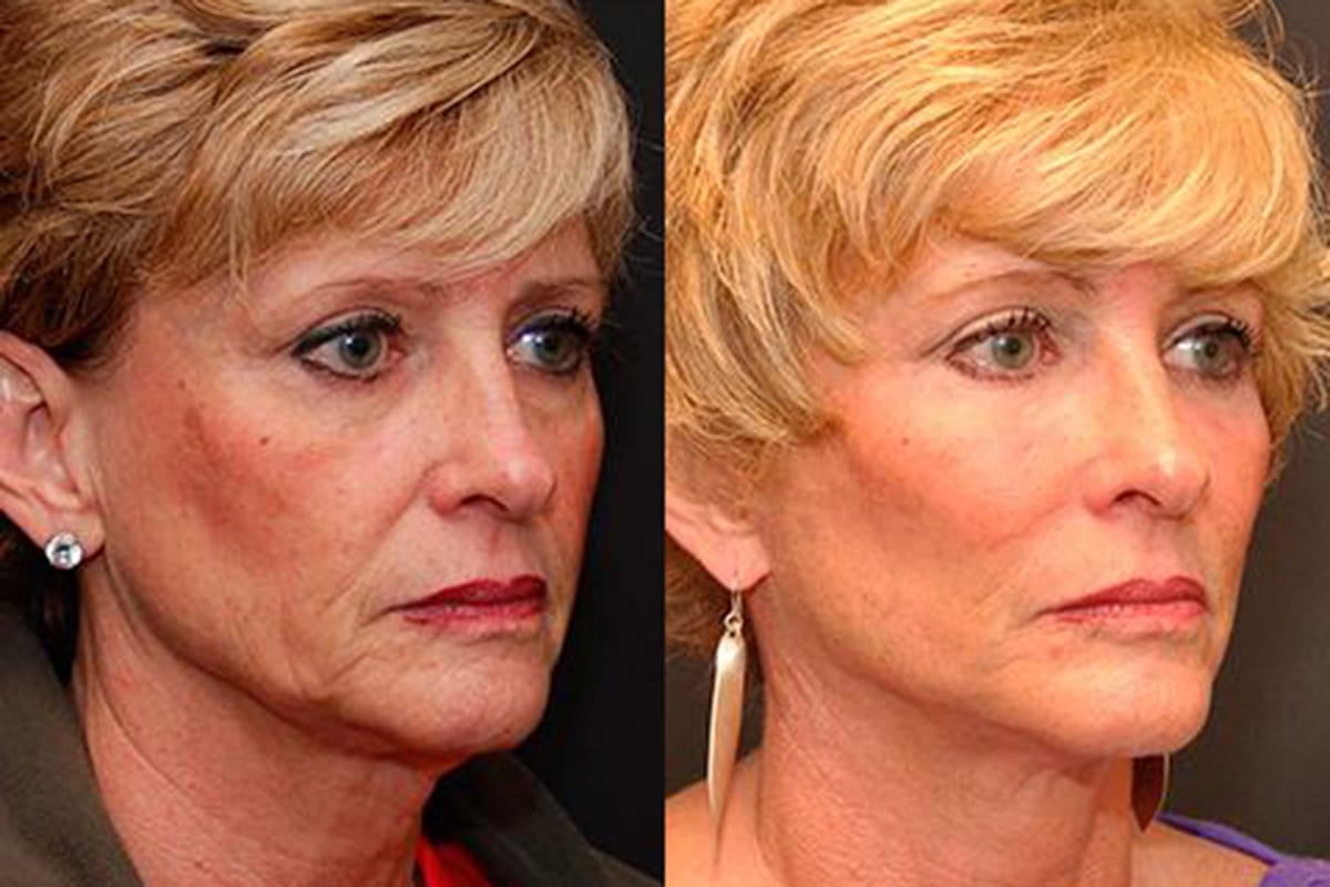 Laser Skin Resurfacing Cincinnati, OH