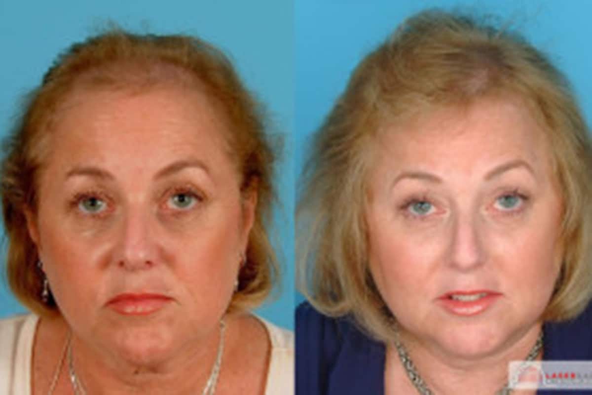 Laser Therapy Cincinnati, OH