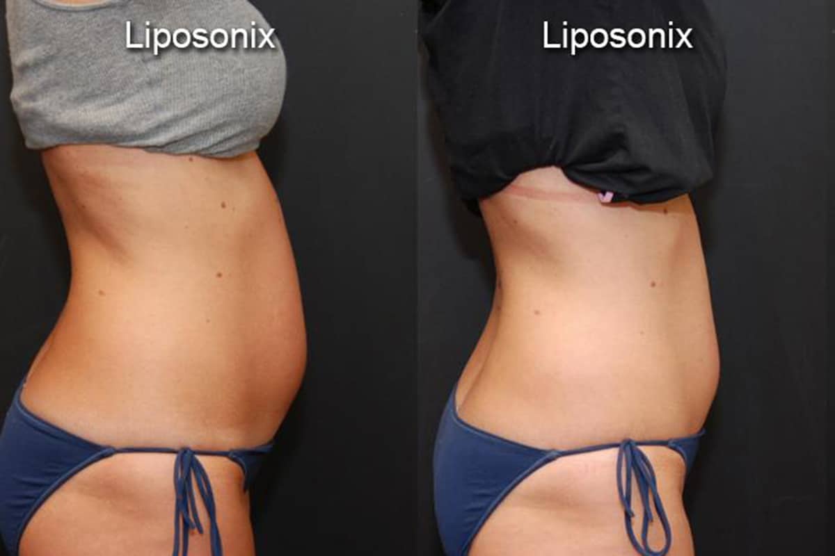 Liposonix Fat Removal Cincinnati, OH Non Invasive Liposuction