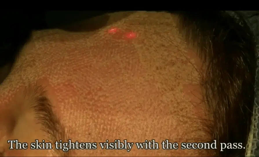 laser-skin-resurfacing-thumbnail