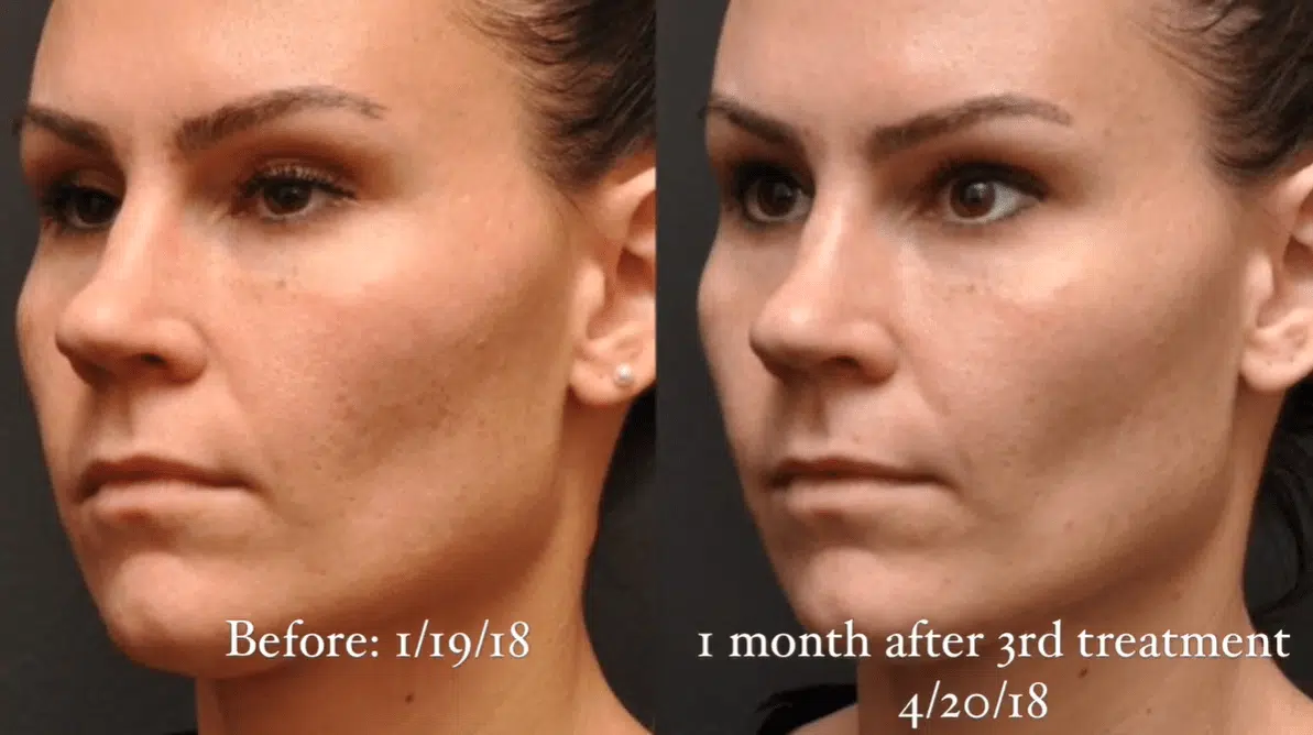 Before and After
