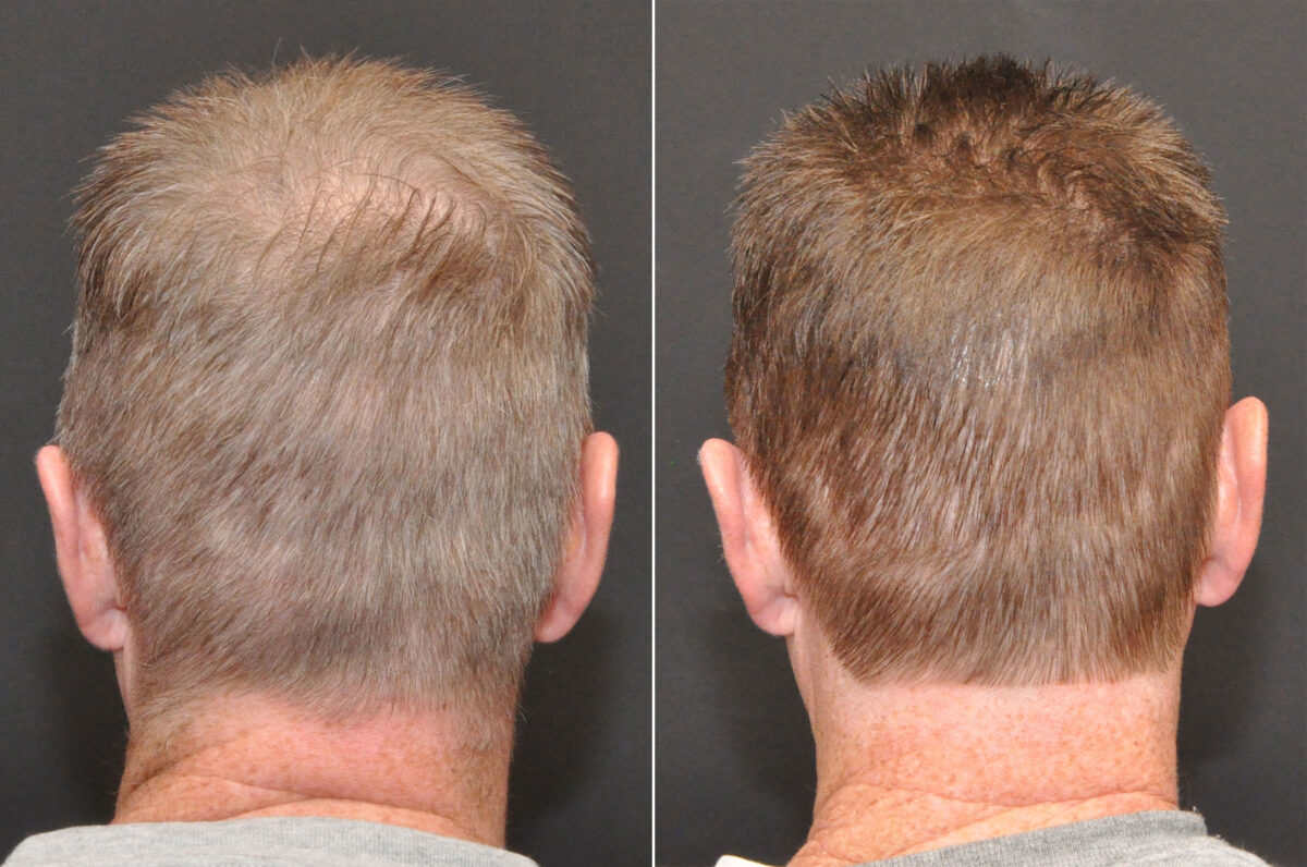 Hair Transplantation Before and After Photos in Cincinnati, OH, Patient 6833