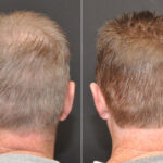 Hair Transplantation Before and After Photos in Cincinnati, OH, Patient 6833