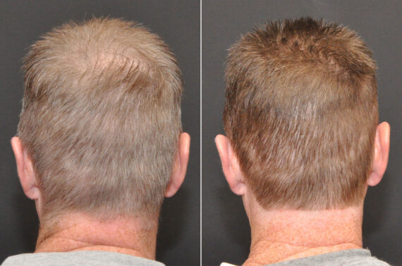 Hair Transplantation Before and After Photos in Cincinnati, OH, Patient 6833