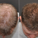 Hair Transplantation Before and After Photos in Cincinnati, OH, Patient 6833