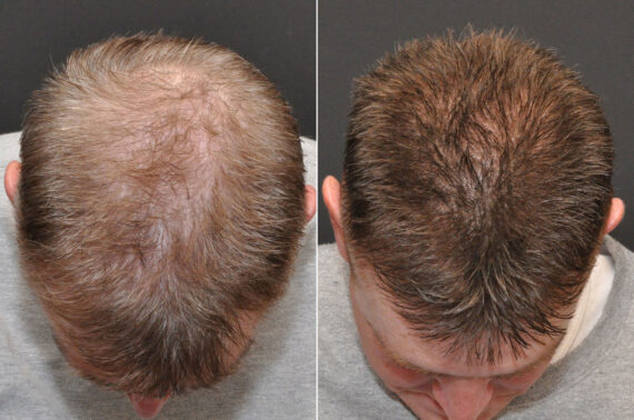 Hair Transplantation Before and After Photos in Cincinnati, OH