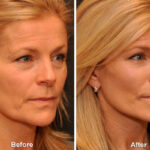 Fat Transfer Before and After Photos in Cincinnati, OH, Patient 5741
