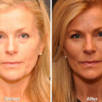 Fat Transfer Before and After Photos in Cincinnati, OH, Patient 5741