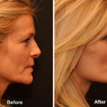 Fat Transfer Before and After Photos in Cincinnati, OH, Patient 5741