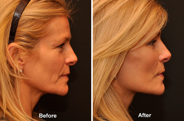 Fat Transfer Before and After Photos in Cincinnati, OH, Patient 5741
