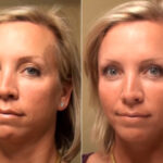 Cosmetic Injectables Before and After Photos in Cincinnati, OH, Patient 9213