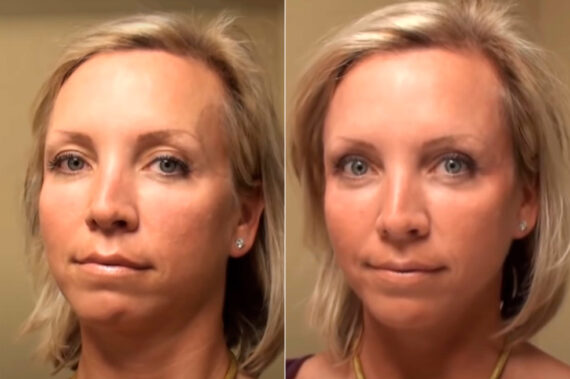 Cosmetic Injectables Before and After Photos in Cincinnati, OH, Patient 9213