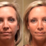 Cosmetic Injectables Before and After Photos in Cincinnati, OH, Patient 9213