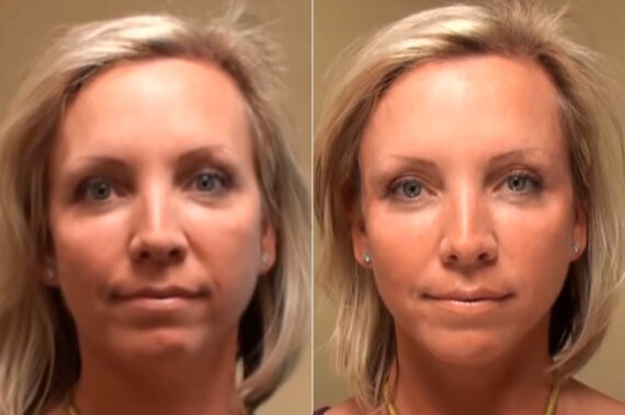 Cosmetic Injectables Before and After Photos in Cincinnati, OH, Patient 9213