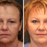 Brow lift Before and After Photos in Cincinnati, OH, Patient 6053