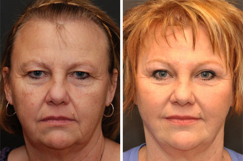 Brow lift Before and After Photos in Cincinnati, OH