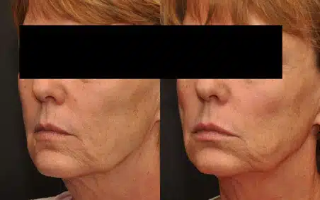 Before and After