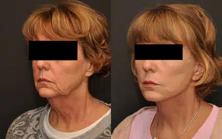 Before and After
